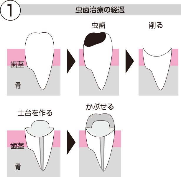 虫歯治療1